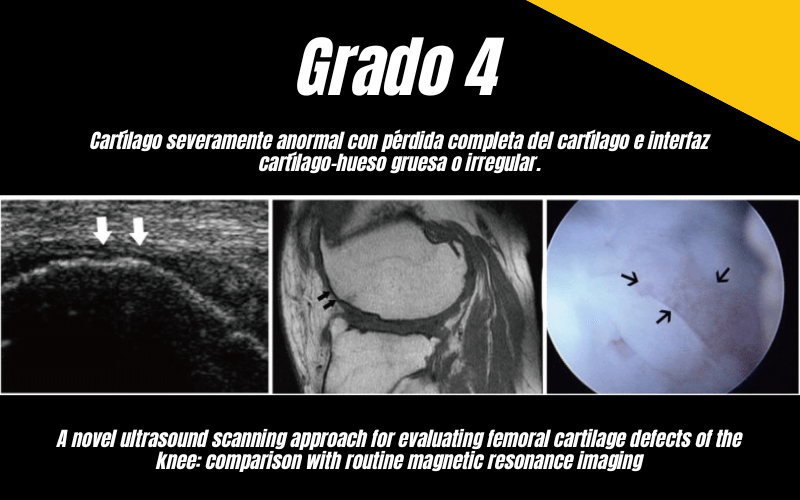 7. Ecografia Tempo formacion Cartilago Femoral.png